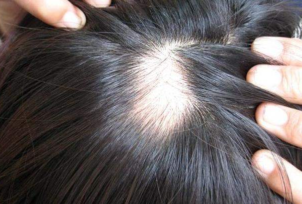 脱发的类型和治疗方法都有哪些?男女性脱发处理